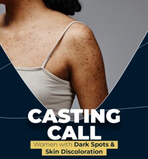 Casting People in Los Angeles with Dark Spots on Skin for Paid Promo