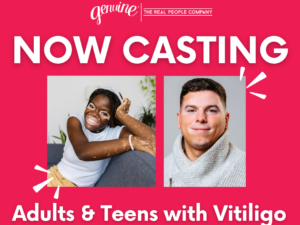 US & Canada Casting Adults & Teens – Non-Segmental Vitiligo